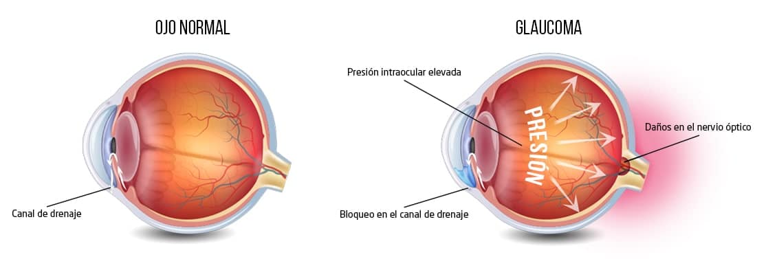 glaucoma