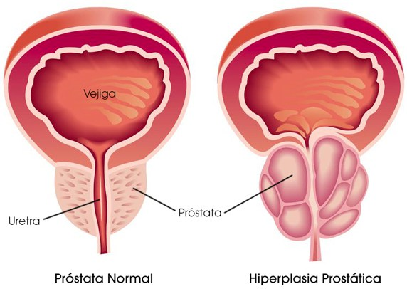 hipertrofia benigna de prostata